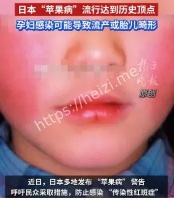 日本苹果病历史